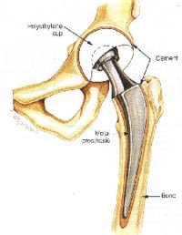 K3-en/PhysChemLab/implants.jpg